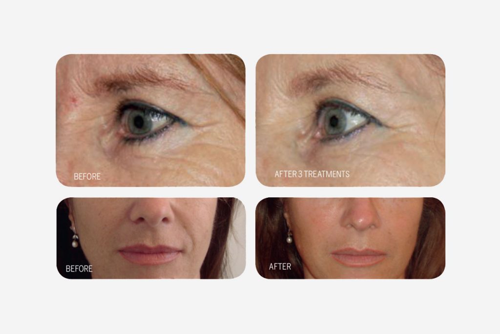 prp-anti-age-med-kroppsegen-plasma-veritaskliniken