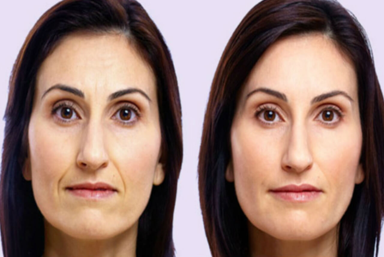 Volite- filler för huden hos Veritasklniken